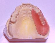 金属を使わない従来の樹脂の部分入れ歯では柔すぎて