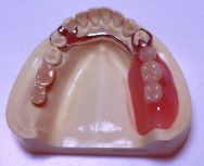 残った歯に金属の留め具を装着すると歯の負担が大きく