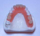 歯全体の部分入れ歯の場合